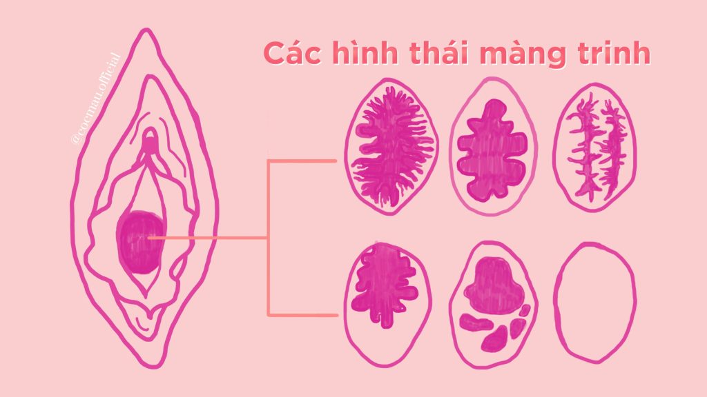 Màng trinh vốn có một lỗ ở giữa để hành kinh và tiết dịch âm đạo. Màng trinh không bị thủng hoặc rách trong lần quan hệ tình dục đầu tiên, mà thường giãn ra. Màng trinh giãn và tiêu biến khá dễ dàng thông qua tập thể thao, tiết dịch âm đạo, thủ dâm hoặc đạp xe.